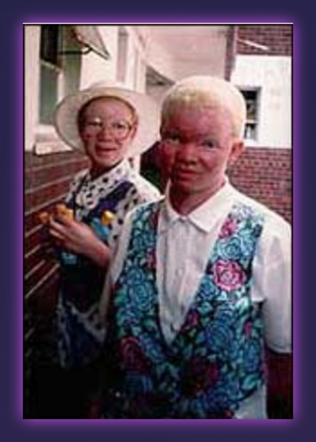 two children with Albinism